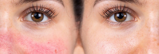 Red Light Therapy for Rosacea: What You Need to Know