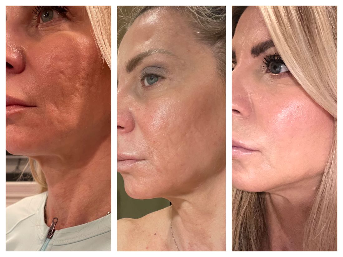 Red Light Therapy for Face: Before and After Stories That Say It All