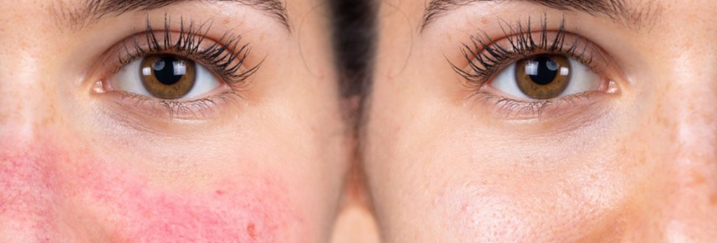 Red Light Therapy for Rosacea: What You Need to Know