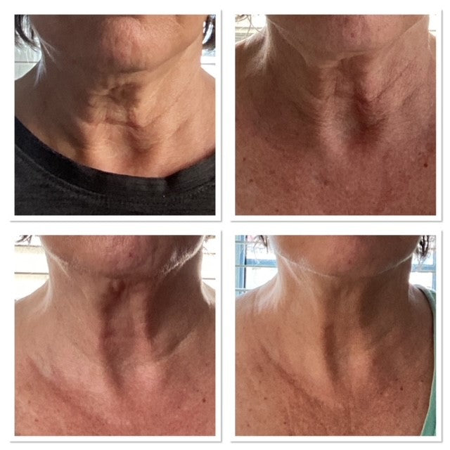 Red Light Therapy for Chest Wrinkles: Restore Smooth, Youthful Skin