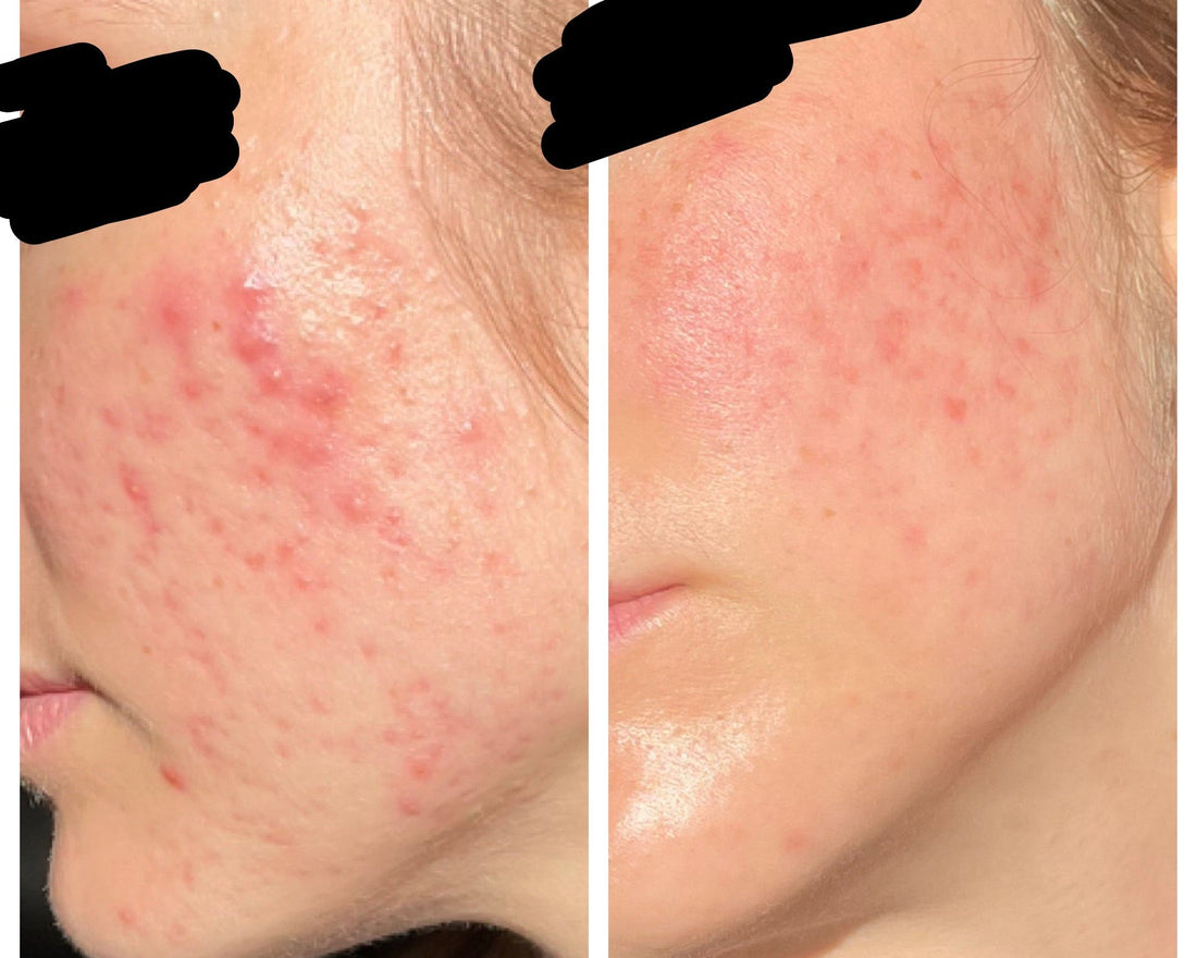 How to Reduce Redness on Face: Causes, Treatments, and Skincare Strategies